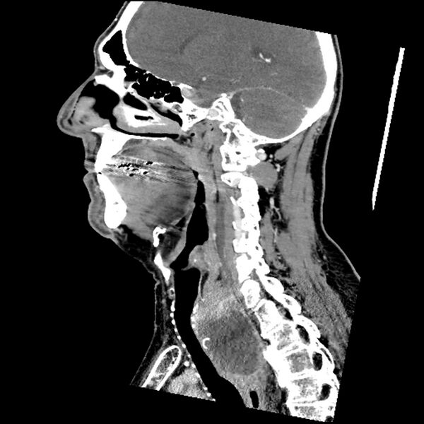 File:Anaplastic thyroid carcinoma (Radiopaedia 79087-92034 C 54).jpg