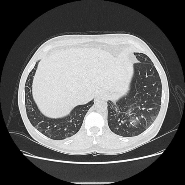 File:Angioinvasive aspergellosis (Radiopaedia 66995-76315 Axial lung window 44).jpg