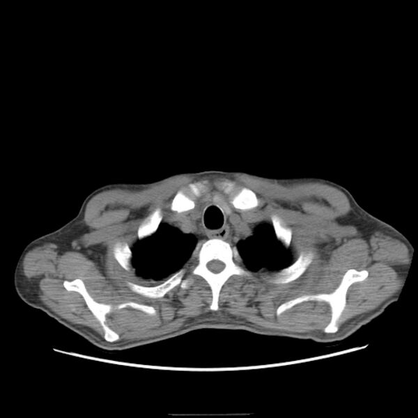 File:Angioinvasive aspergellosis (Radiopaedia 66995-76315 Axial non-contrast 3).jpg