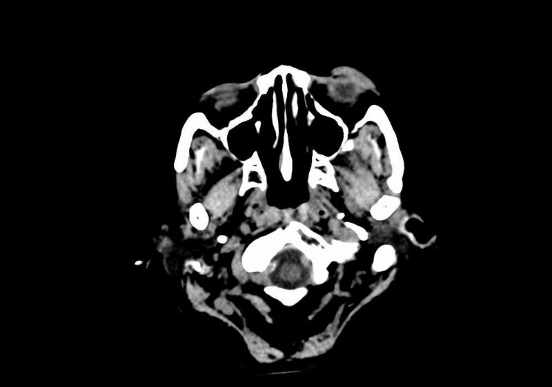 File:Anomalous intracranial venous drainage (Radiopaedia 28161-28418 Axial non-contrast 1).jpg