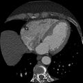 Anomalous origin of left circumflex artery from right coronary sinus (Radiopaedia 72563-83117 B 113).jpg