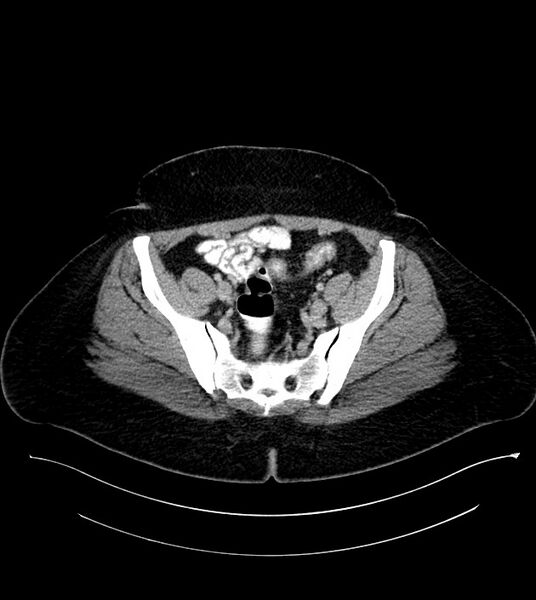 File:Anterior abdominal wall CSF pseudocyst (CSFoma) (Radiopaedia 79453-92571 A 73).jpg
