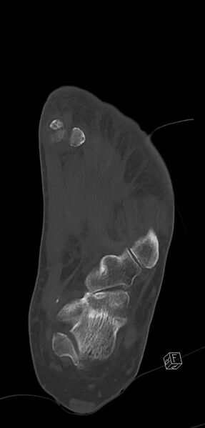 File:Anterior calcaneal process fracture (Radiopaedia 63353-71943 Coronal bone window 31).jpg