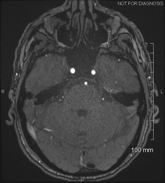 File:Anterior cerebral artery aneurysm (Radiopaedia 80683-94127 Axial MRA 67).jpg