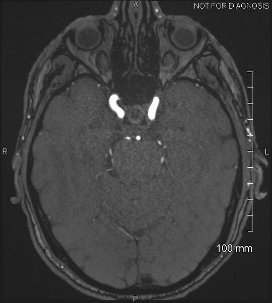 File:Anterior cerebral artery aneurysm (Radiopaedia 80683-94127 Axial MRA 82).jpg