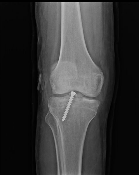 File:Anterior cruciate ligament bony avulsion (Radiopaedia 12579-12801 Frontal 1).jpg