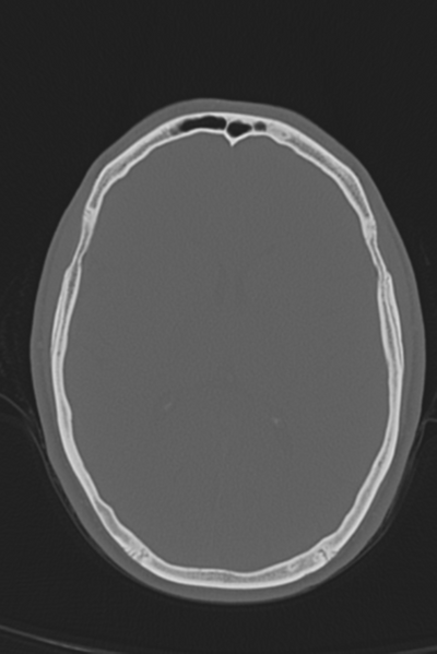 File:Anterior nasal spine fracture (Radiopaedia 46138-50494 Axial bone window 28).png