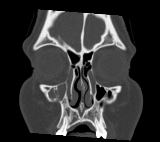 File:Antrochoanal polyp (Radiopaedia 21894-21868 Coronal bone window 6).jpg