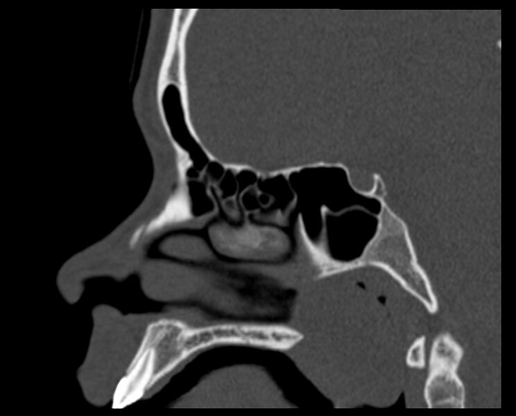 File:Antrochoanal polyp (Radiopaedia 21894-21868 Sagittal bone window 22).jpg