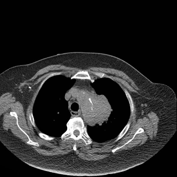 File:Aortic arch false aneurysm (Radiopaedia 14667-14587 Axial non-contrast 7).jpg