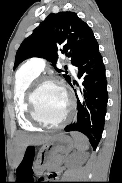 File:Aortic coarctation with aneurysm (Radiopaedia 74818-85828 B 107).jpg