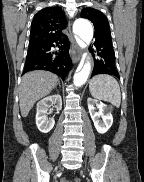 File:Aortic dissection (Radiopaedia 44411-48061 A 40).jpg