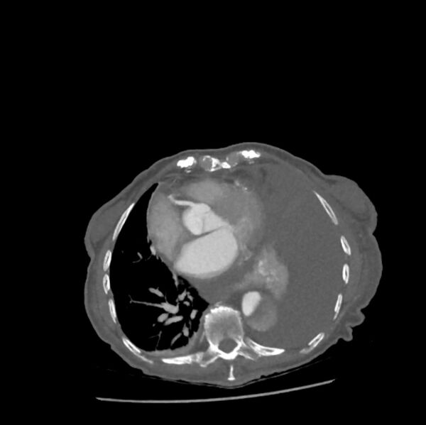 File:Aortic dissection (Radiopaedia 68763-78691 A 36).jpeg