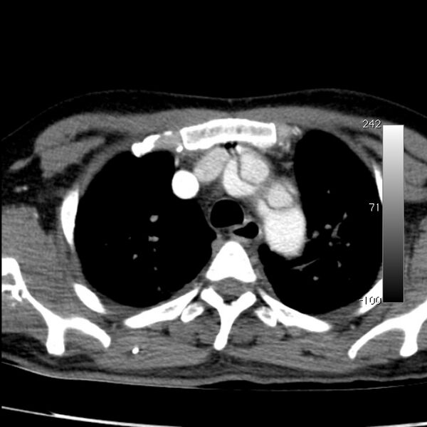 File:Aortic dissection - Stanford type A (Radiopaedia 29247-29659 A 19).jpg