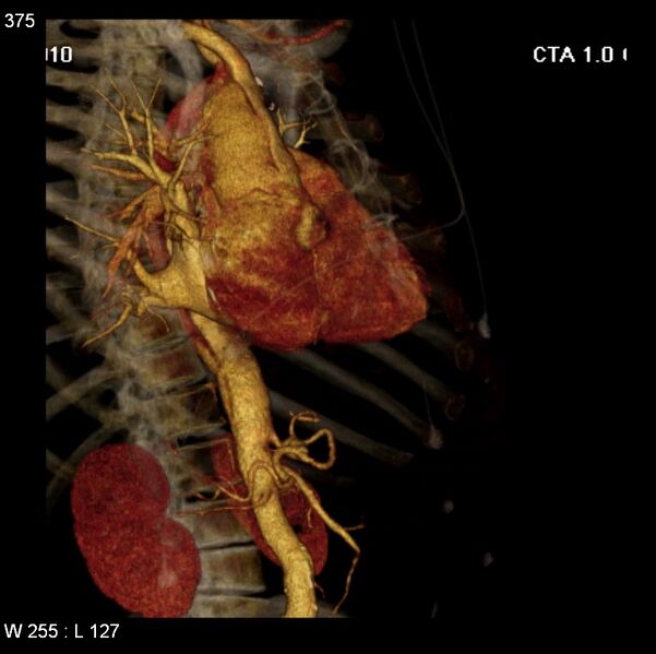 File:Aortic dissection with rupture into pericardium (Radiopaedia 12384-12647 C+ arterial phase 7).jpg