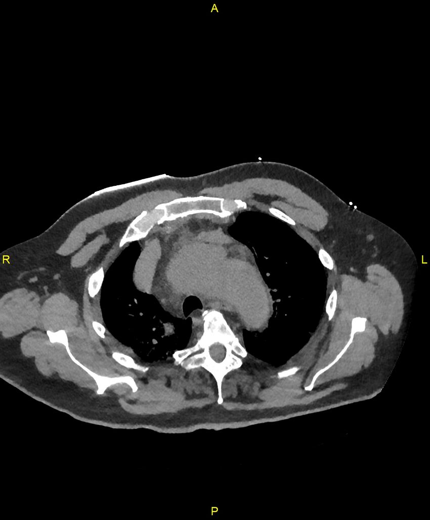 Aortic rupture (Radiopaedia 88822-105594 Axial non-contrast 46).jpg