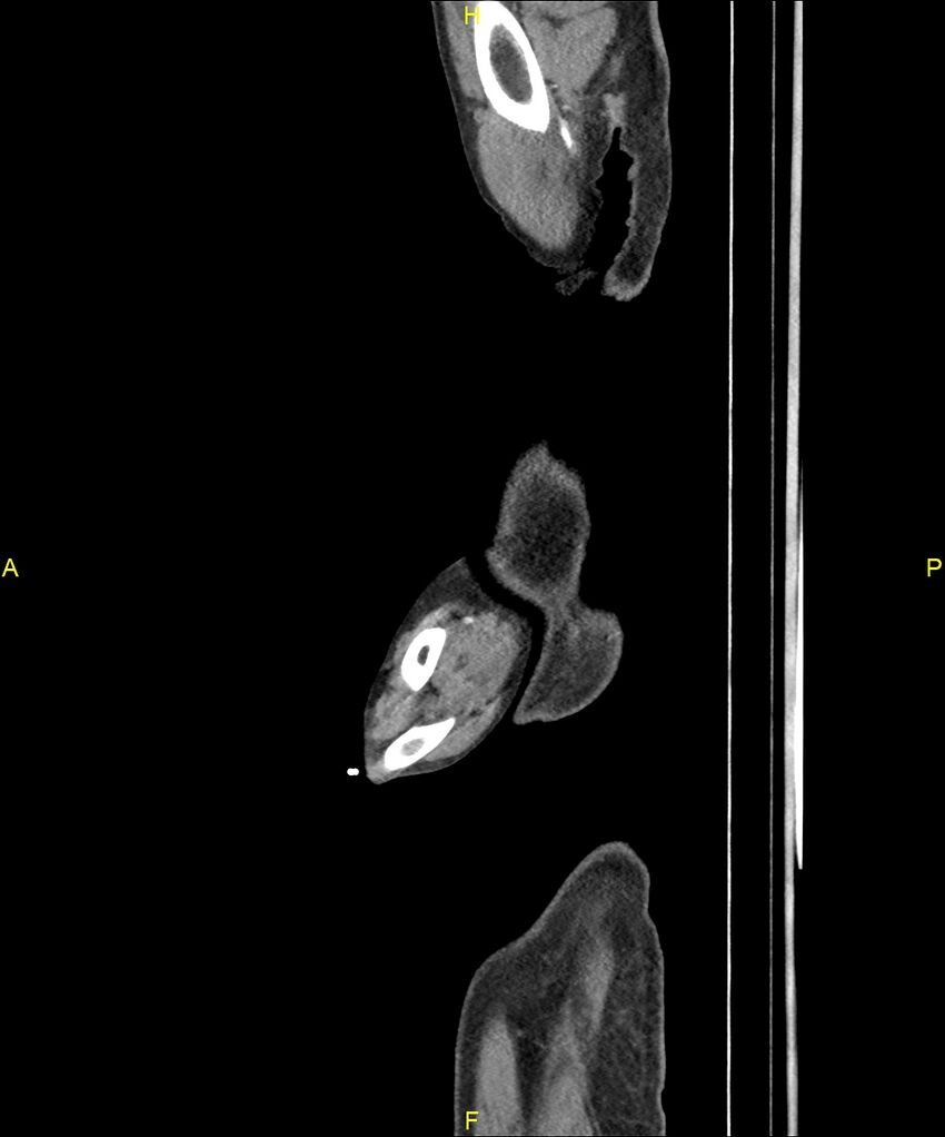 Aortoenteric fistula (Radiopaedia 84308-99603 C 1).jpg