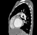 Aortopulmonary window, interrupted aortic arch and large PDA giving the descending aorta (Radiopaedia 35573-37074 C 36).jpg