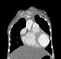Aortopulmonary window, interrupted aortic arch and large PDA giving the descending aorta (Radiopaedia 35573-37074 D 13).jpg