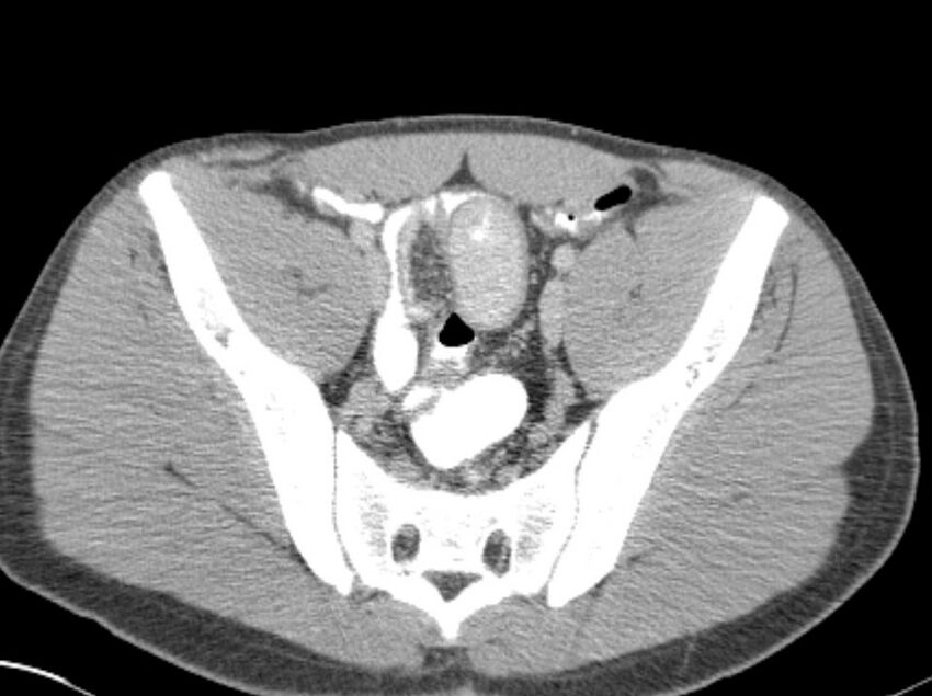 Appendicitis and incidental foregut duplication cyst (Radiopaedia 52962-58916 A 79).jpg