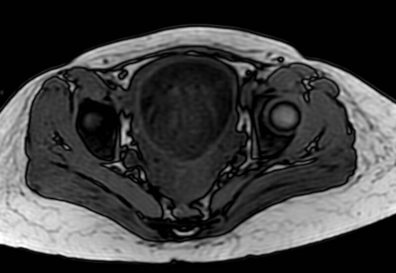 File:Appendicitis in gravida (MRI) (Radiopaedia 89433-106395 D 62).jpg