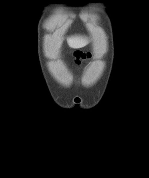 File:Appendicitis with cecal bar sign (Radiopaedia 31878-32830 A 8).jpg