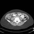 Appendicitis with minimal stranding but appendicolith (Radiopaedia 29035-29397 A 54).jpg