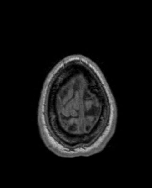 File:Arachnoid cyst- extremely large (Radiopaedia 68741-78451 Axial T1 73).jpg
