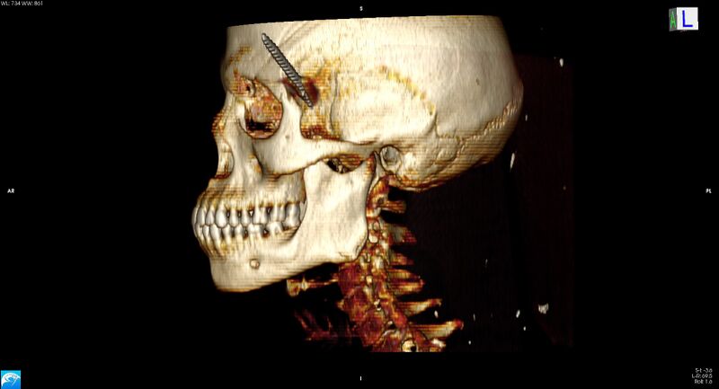 File:Arrow injury to the head (Radiopaedia 75266-86388 3D horizontal 17).jpg