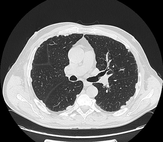 File:Asbestos pleural placques (Radiopaedia 57905-64872 Axial lung window 113).jpg