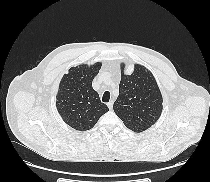 File:Asbestos pleural placques (Radiopaedia 57905-64872 Axial lung window 56).jpg