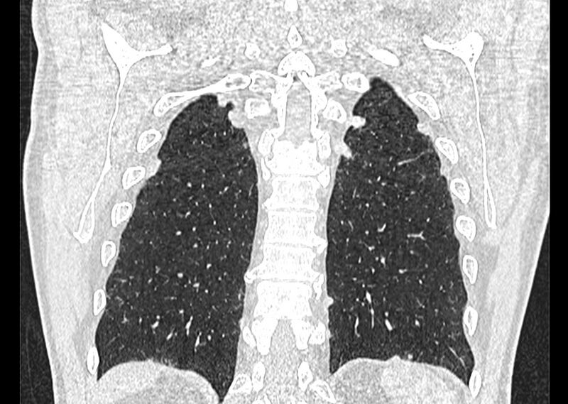 File:Asbestos pleural placques (Radiopaedia 57905-64872 Coronal lung window 241).jpg