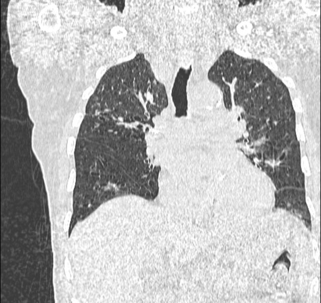 File:Aspergilloma (Radiopaedia 44592-48327 Coronal lung window 59).jpg