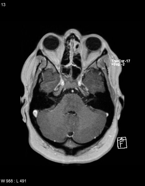 File:Astroblastoma (Radiopaedia 39792-42217 Axial T1 C+ 12).jpg