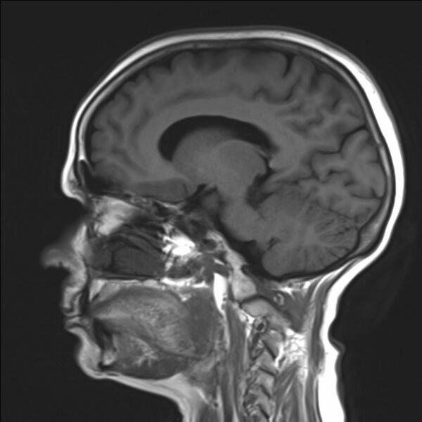 File:Atlanto-occipital assimilation with basilar invagination (Radiopaedia 70122-80157 Sagittal T1 14).jpg
