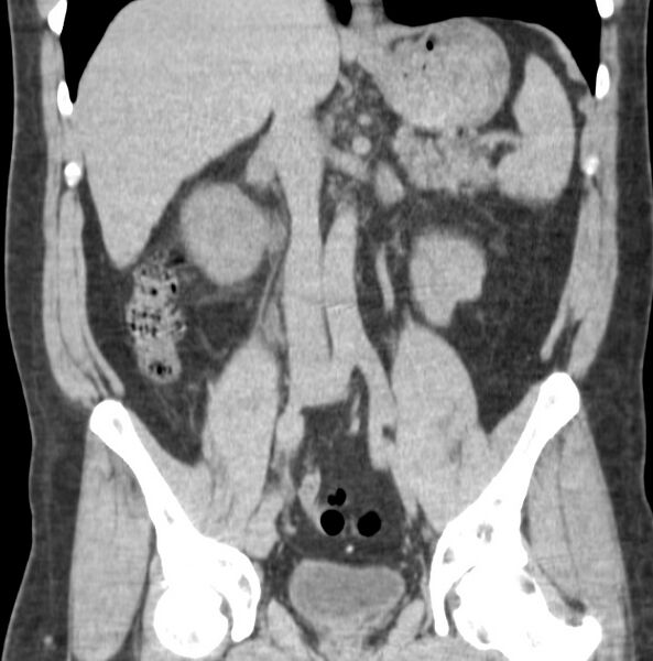 File:Atrophic kidney due to severe chronic obstructive hydronephrosis (Radiopaedia 40828-43474 Coronal non-contrast 2).jpg
