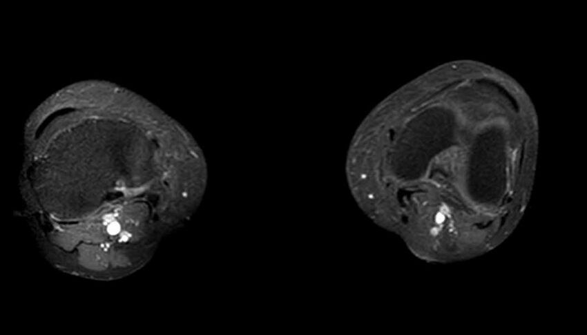 Atypical lipomatous tumor - thigh (Radiopaedia 68975-78734 Axial T1 C+ fat sat 5).jpg