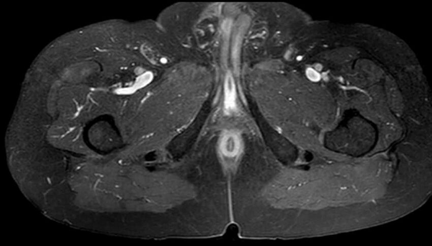 Atypical lipomatous tumor - thigh (Radiopaedia 68975-78734 Axial T1 C+ fat sat 81).jpg