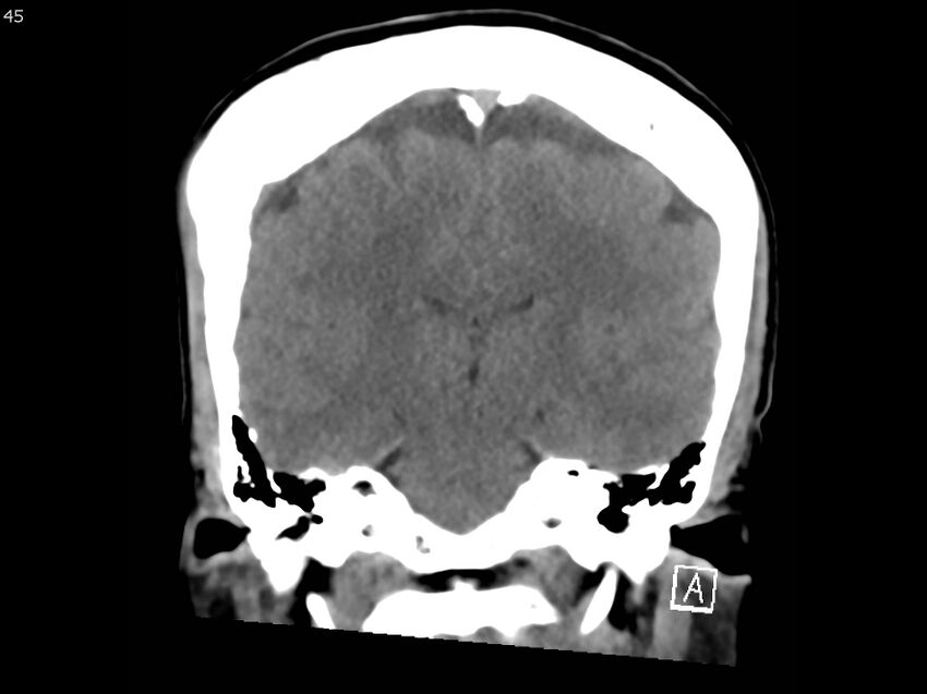 Atypical meningioma - intraosseous (Radiopaedia 64915-73867 B 44).jpg