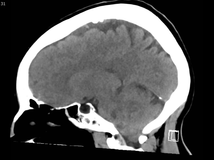 Atypical meningioma - intraosseous (Radiopaedia 64915-73867 C 29).jpg