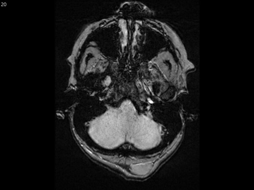 Atypical meningioma - intraosseous (Radiopaedia 64915-74572 Axial SWI 20).jpg