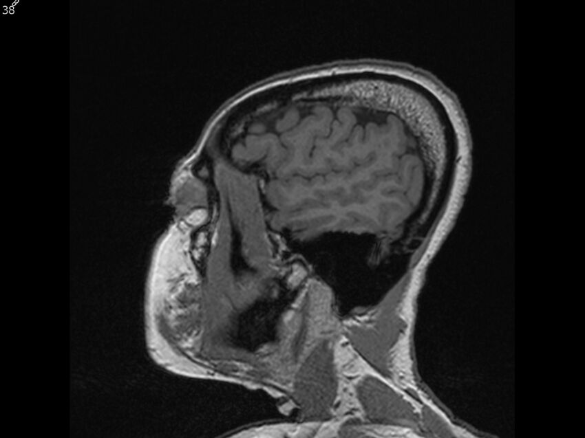 Atypical meningioma - intraosseous (Radiopaedia 64915-74572 Sagittal T1 38).jpg