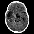 Atypical teratoid rhabdoid tumor (AT-RT) (Radiopaedia 6073-7552 Axial non-contrast 1).jpg