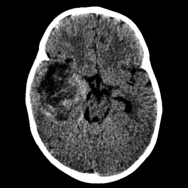 File:Atypical teratoid rhabdoid tumor (AT-RT) (Radiopaedia 6073-7552 Axial non-contrast 1).jpg