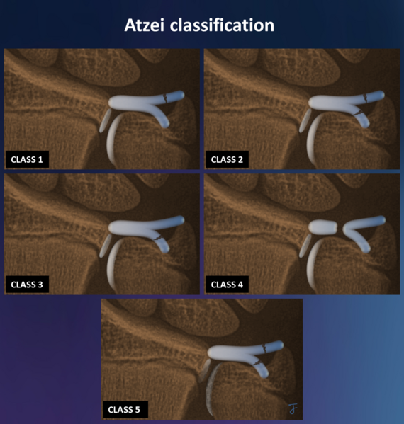 File:Atzei classification of peripheral TFCC tears (Radiopaedia 76784).png