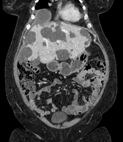 File:Autosomal dominant polycystic kidney disease (Radiopaedia 57124-64017 B 21).jpg