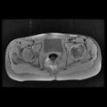 Avascular necrosis of the hip (Radiopaedia 29563-30067 Axial T1 fat sat 8).jpg