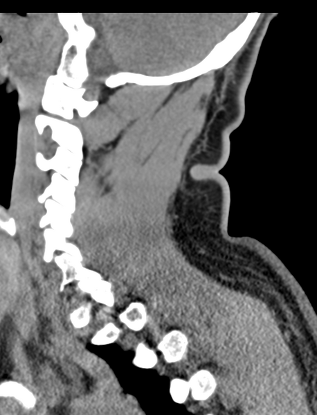 File:Axis peg fracture (type 3) and atlas lateral mass (type 4) fracture (Radiopaedia 37474-39324 D 25).png