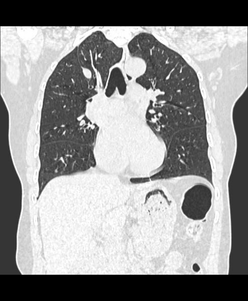 File:Azygos fissure and azygos lobe (Radiopaedia 41841-44832 Coronal lung window 7).jpg