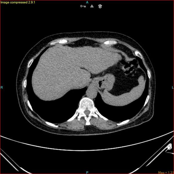 File:Azygos vein aneurysm (Radiopaedia 77824-90130 A 48).jpg